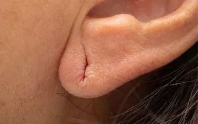 Ear Lobe Correction Treatment in Chandlodiya