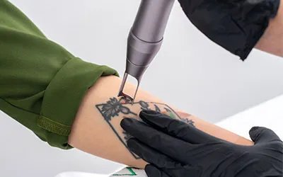 Laser Tattoo Removal Treatment in New Ranip