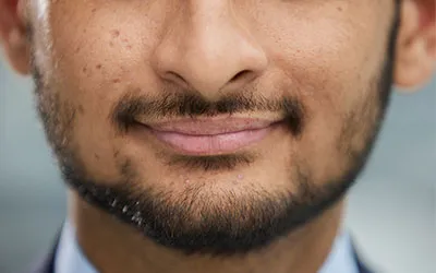 Moustache / Beard Transplantation Treatment in New Ranip